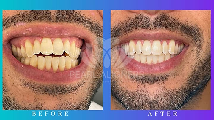 Before and After with Pearl Aligners