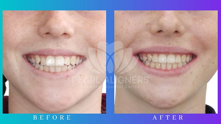 Before and After with Pearl Aligners