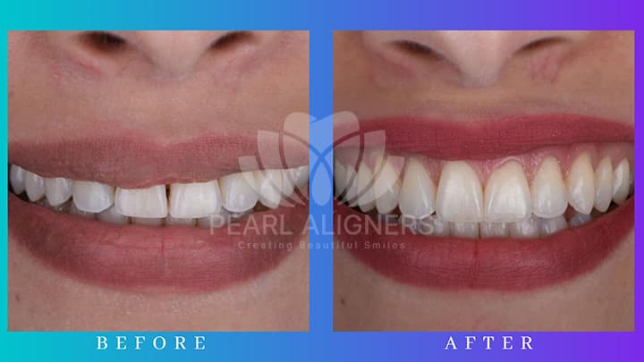 Before and After with Pearl Aligners