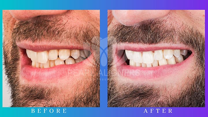 Before and After with Pearl Aligners