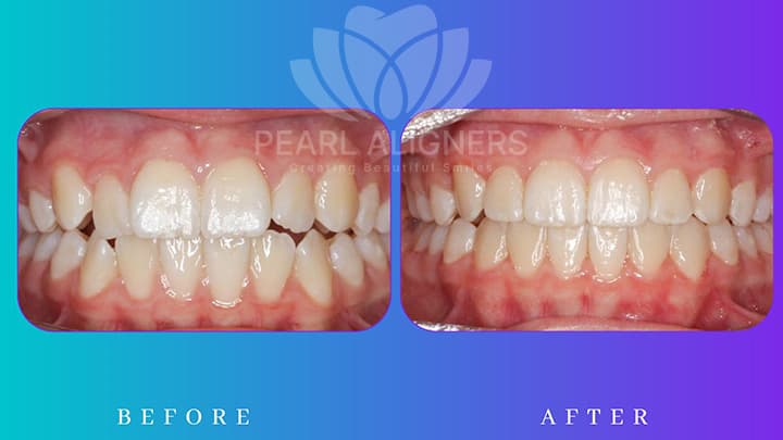 Before and After with Pearl Aligners